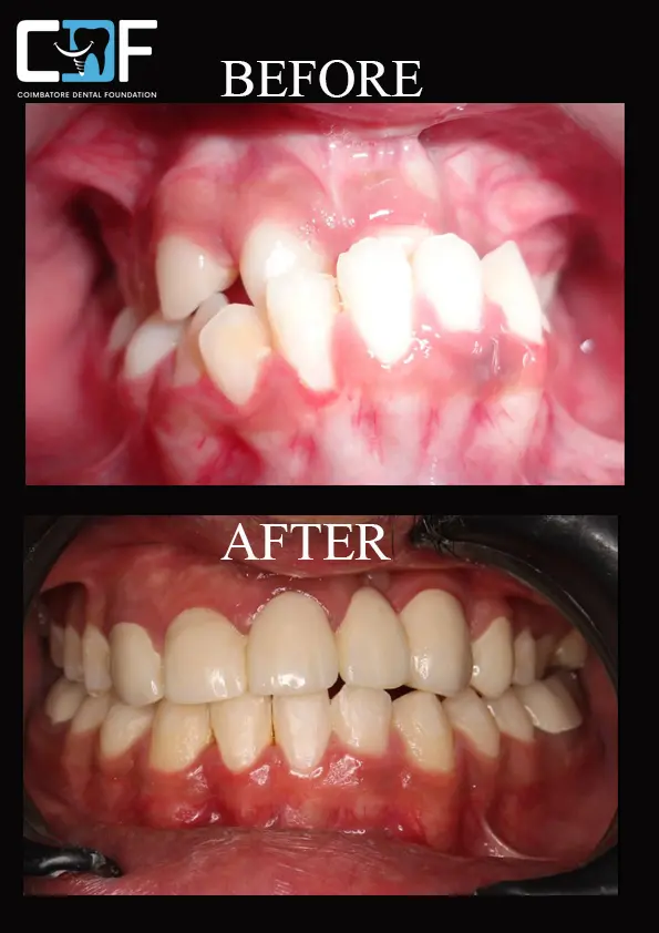 Braces Intraoral